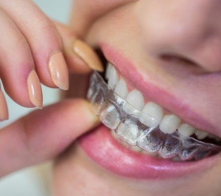 A person placing a clear dental aligner over their teeth, showing a close-up of their mouth and hand.