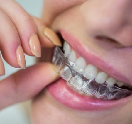 A person placing a clear dental aligner over their teeth, showing a close-up of their mouth and hand.
